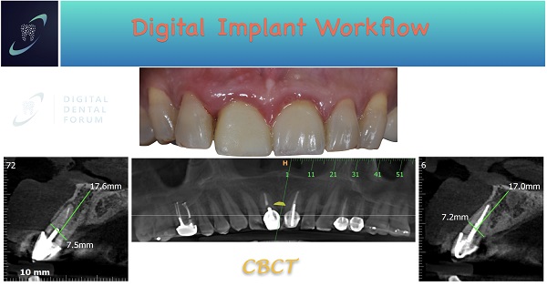 digital implant workflow