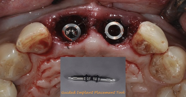 guided implant placement tool